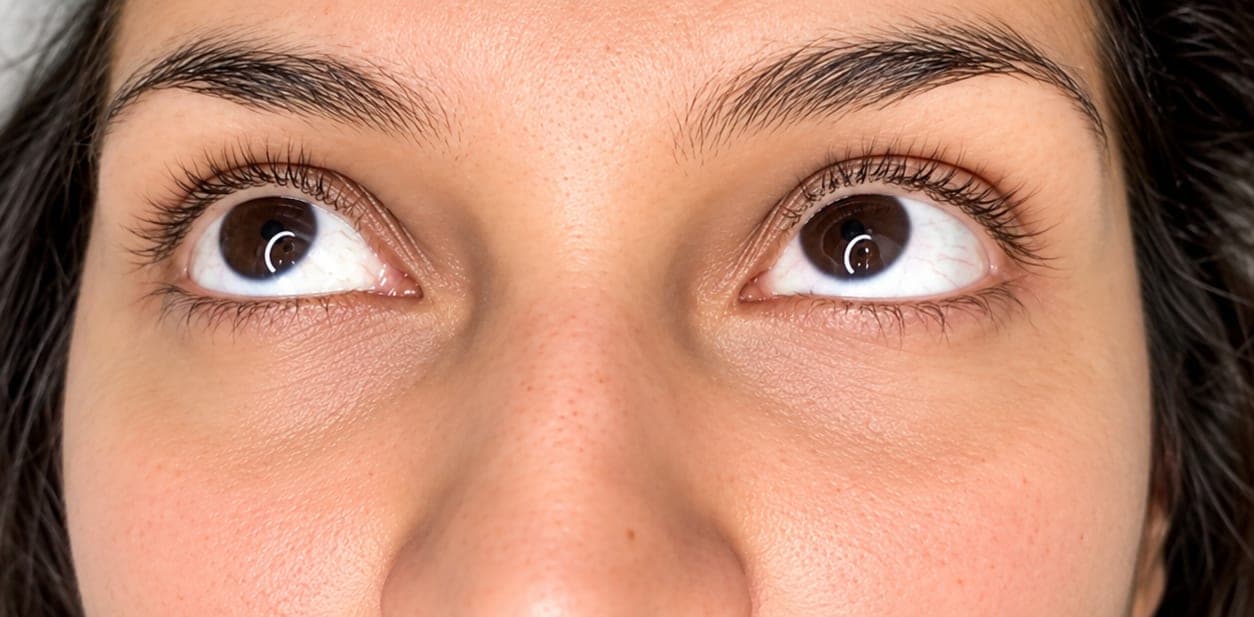 Região dos olhos com olheiras suavizadas após tratamento